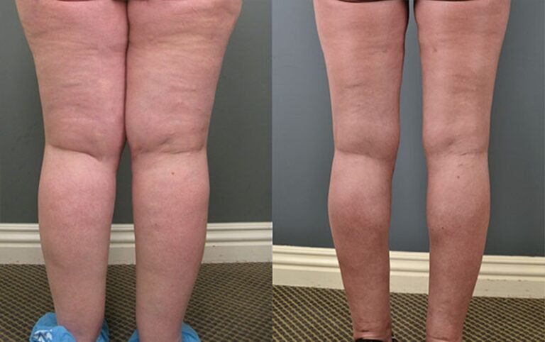lipedema-antes-e-depois19.jpg